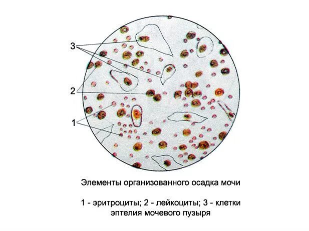 Эритроциты и лейкоциты в моче у мужчин. Эритроциты выщелоченные микроскопия. Нечипоренко моча микроскопия. Как выглядят лейкоциты и эритроциты в моче. Форменные элементы в моче.