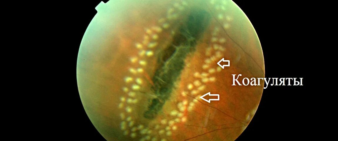 Периферические ретинальные дегенерации. Лазеркоагуляция сетчатки ПВХРД. Мелкокистозная дистрофия сетчатки. Дистрофия сетчатки след улитки.