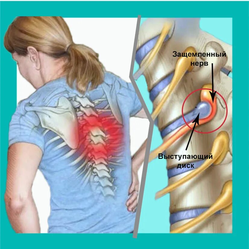 Болит спина защемление. Спиной нерв. Ущемление спинного нерва. Защемление нерва в пояснице.