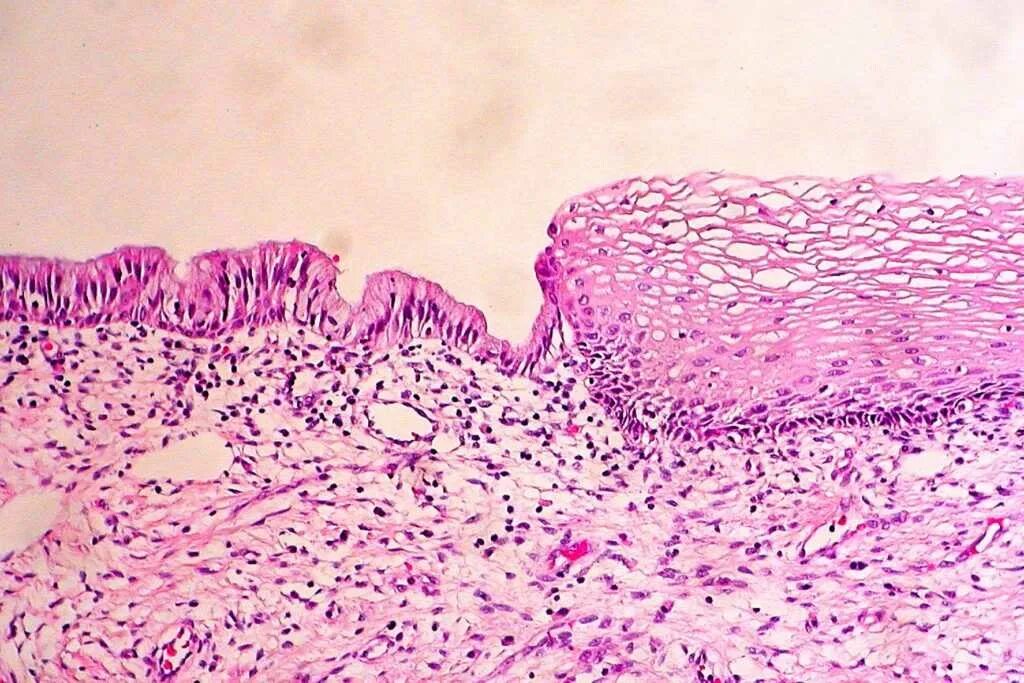 Плоскоклеточная метаплазия шейки матки гистология. Эктопия шейки матки гистология. Метаплазия матки гистология. Цилиндрический эпителий шейки матки гистология. Эндоцервикс цилиндрический