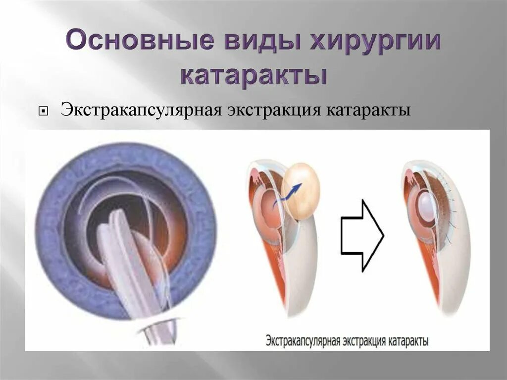 Экстракция увеальной катаракты. Интракапсулярная и экстракапсулярная экстракция катаракты. Интракапсулярная экстракция катаракты техника. Интракапсулярная экстракция катаракты этапы. Виды хирургического лечения