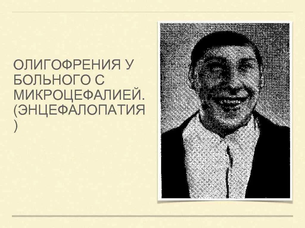 Страдающий олигофренией. Олигофрения. Олигофрения к больного с микроцефалией. Олигофрения фото больных.