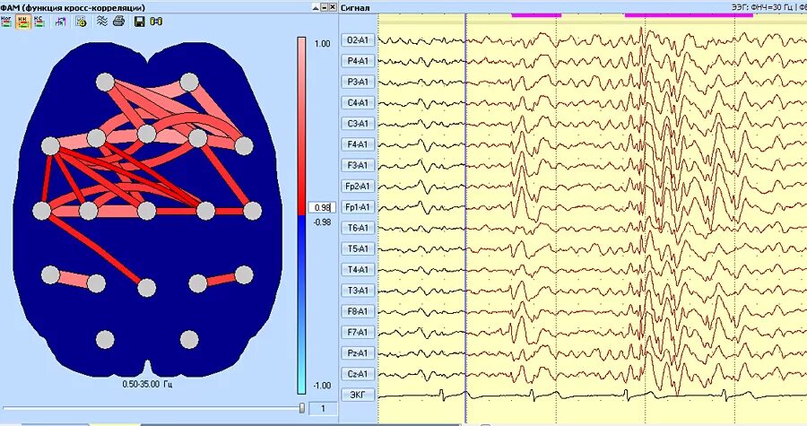 Ээг ульяновск. ТМС ЭЭГ. Эпилептиформная активность на ЭЭГ. ЭКГ ЭЭГ ЭМГ. Синхронизация ЭЭГ.