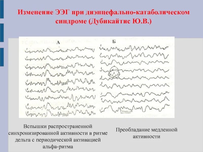 ЭЭГ. Изменения на ЭЭГ. Вспышка Альфа ритма ЭЭГ. Дельта активность на ЭЭГ.