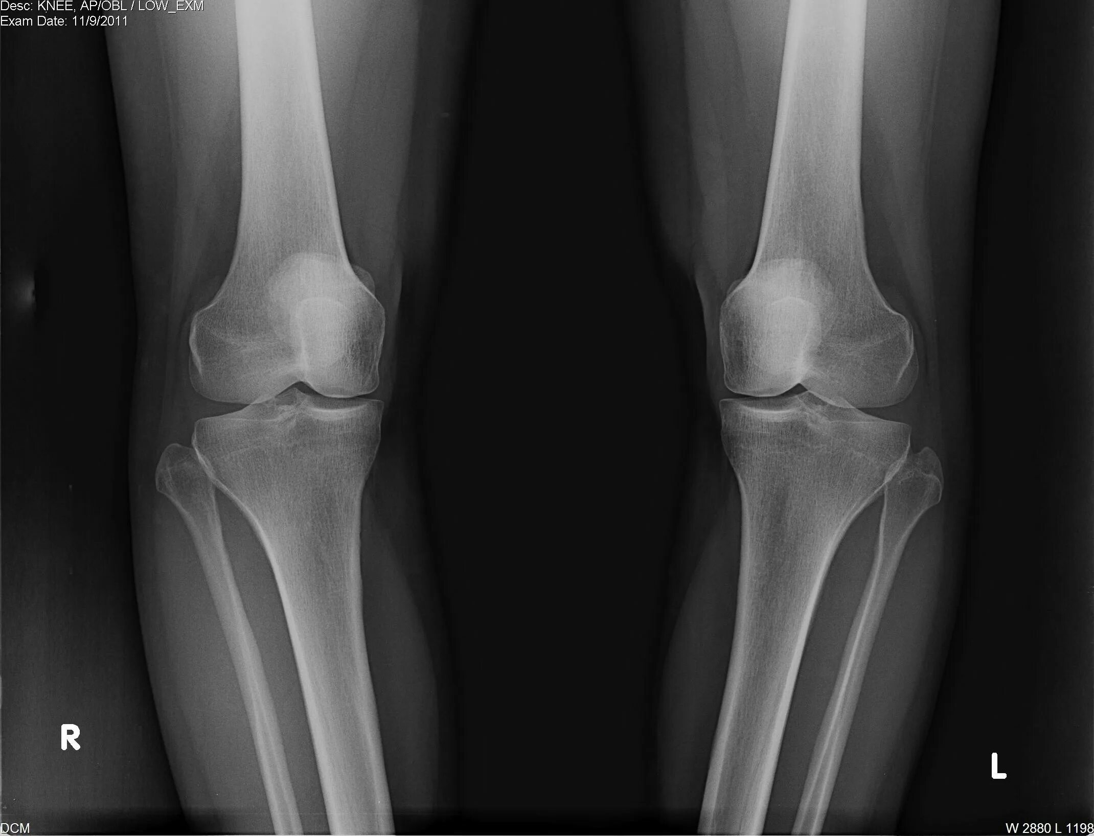 Рентген костей голени норма. Рентгенография костей голени. Рентгеновский снимок ноги.