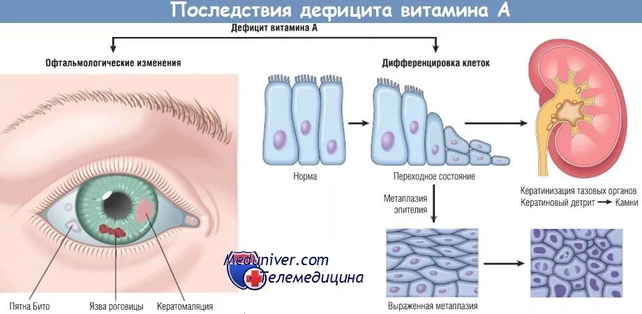 Как изменится количество витамина а после пореза. Последствия дефицита витаминов. Дефицит ретинола симптомы. Последствия нехватки витамина с.