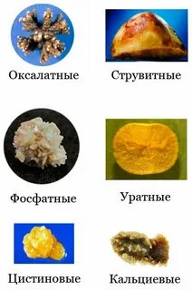 Оксалатные камни в почках причины