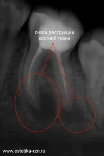 Очаг деструкции