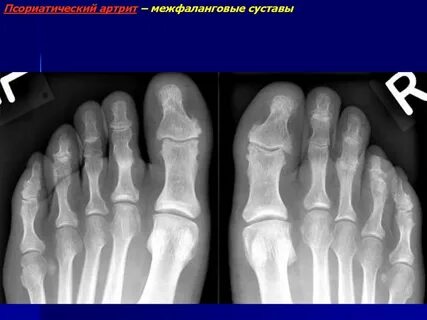 Межфаланговые суставы стопы