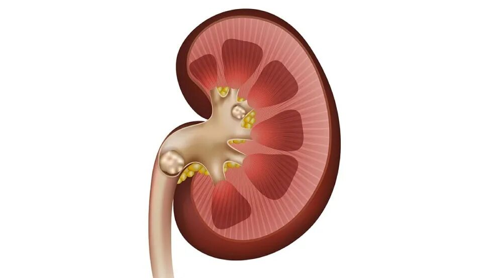 Камни в почках заболевание. Мочекаменная болезнь почек. Мочекаменная болезнь камни. Мочекаменная болезнь у людей. Мочекаменная болезнь у детей.