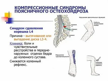 Корешковый синдром. Аксональное поражение нерва что это. Причины аксонопатии. Синдром экстрамедуллярного поражения. Аксональное корешковое поражение.