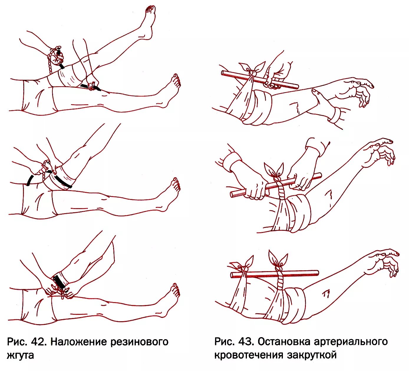 Техника наложения артериального жгута при артериальном кровотечении. Остановка кровотечения накладывание жгута;. Артериальное кровотечение техника наложения жгута. Наложение кровоостанавливающего жгута алгоритм. Как правильно наложить артериальный жгут