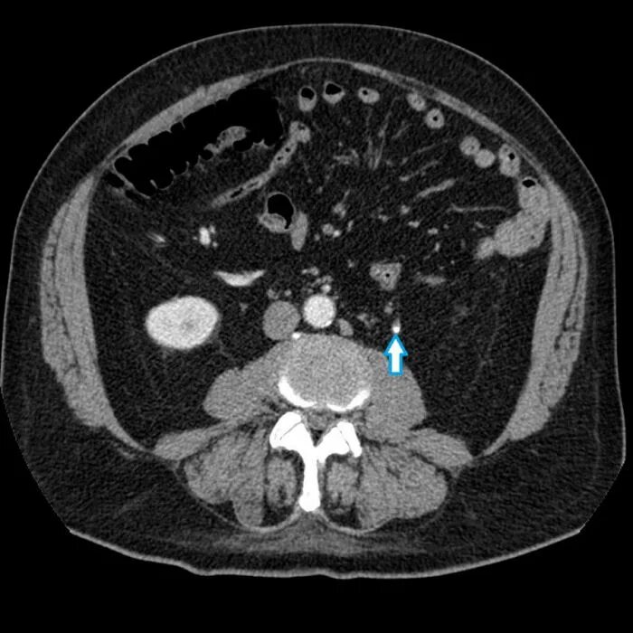 Камни на кт видны. Кт почек мочекаменная болезнь. Мочекаменная болезнь кт. Кт мрт мочекаменной болезни.