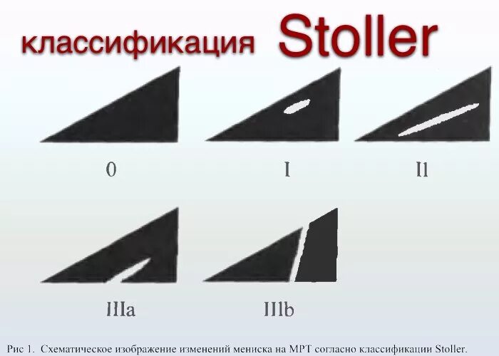 Повреждение мениска коленного сустава по stoller. Классификация по Stoller повреждение мениска. Классификация разрывов мениска по Stoller. Разрывы менисков по Stoller. Stoller классификация повреждения менисков.