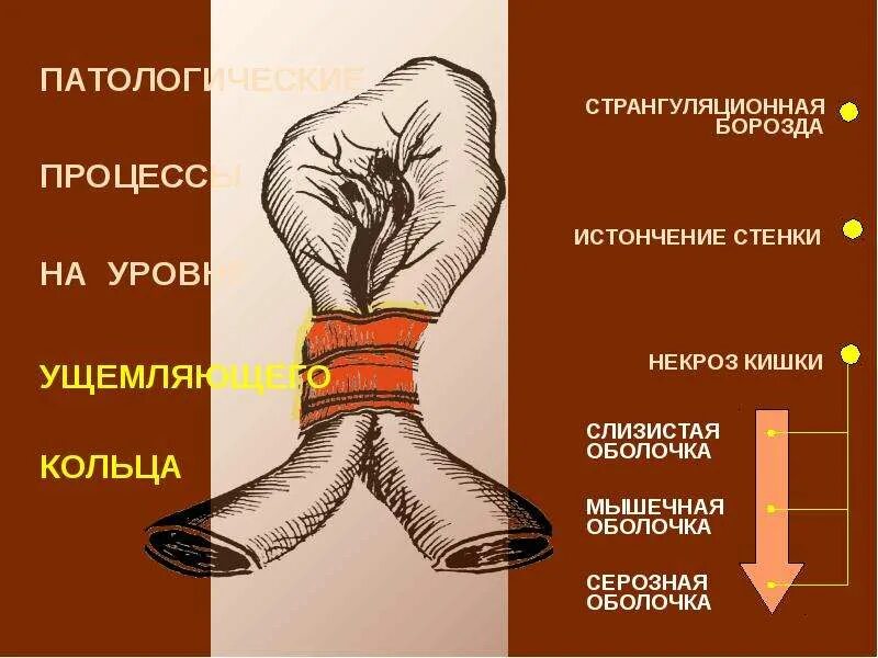 Повешение борозда. Странгуляционная борозда. странгуляционная борозда на кишке. борозда стройгалюционная. странгулярная борозда это.