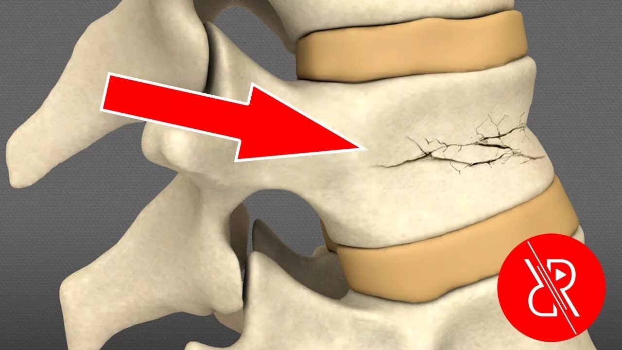 Компрессионный перелом позвоночника т7т8. Компрессионный перелом л3 л4. Компрессионный перелом позвоночника т11. Компрессионный перелом позвоночника l2. Компрессионная операция на позвоночнике