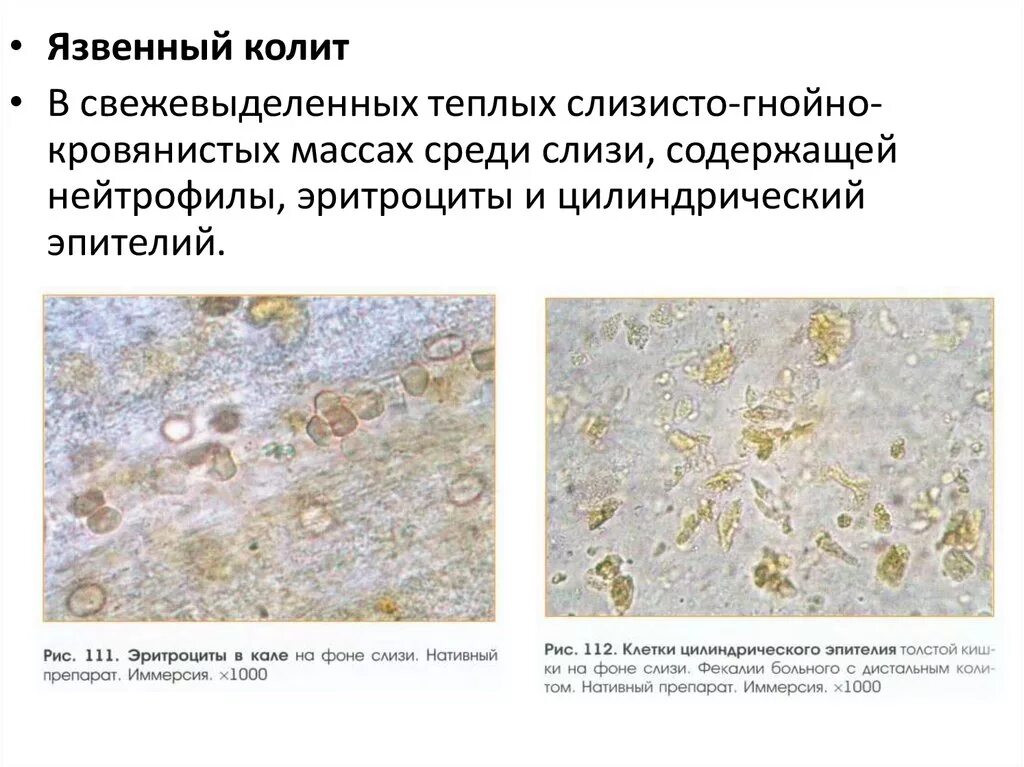 Копрология кала микроскопия лейкоциты. Микроскопия кала соединительная ткань. Микроскопия кала растительная клетчатка непереваримая. Микроскопия кала эритроциты. Эпителий клетки цилиндрического эпителия слизь