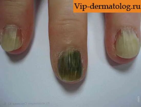 зеленый ноготь после снятия лака