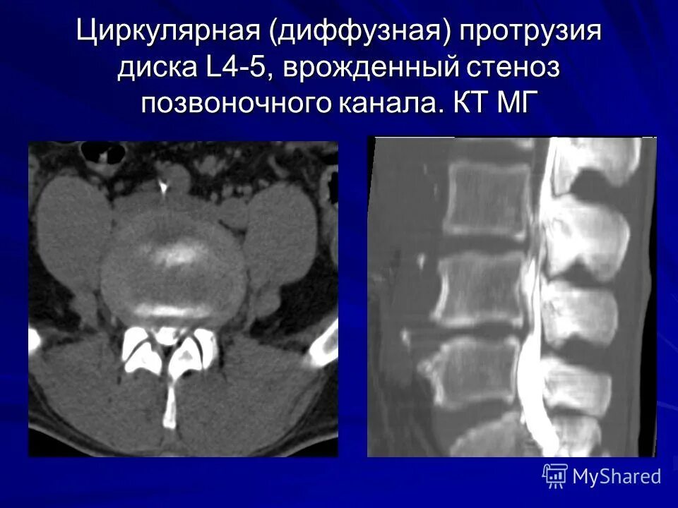 Протрузии дисков на кт. Протрузии дисков у собак. Кт протрузии межпозвонковых дисков. Протрузия межпозвоночного диска на кт. Протрузии мпд на кт.