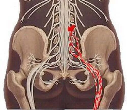 Люмбоишиалгия поясничного отдела позвоночника. Люмбоишиалгия седалищного нерва. Люмбоишиалгия крестцового отдела. Вертебральная люмбалгия.