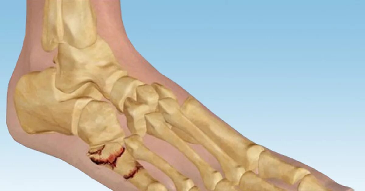 Перелом кости стопы сколько заживает у взрослых. Перелом предплюсны стопы. Перелом костей предплюсны. Перелом кубовидной кости симптомы. Перелом 5 плюсневой кости гипс.