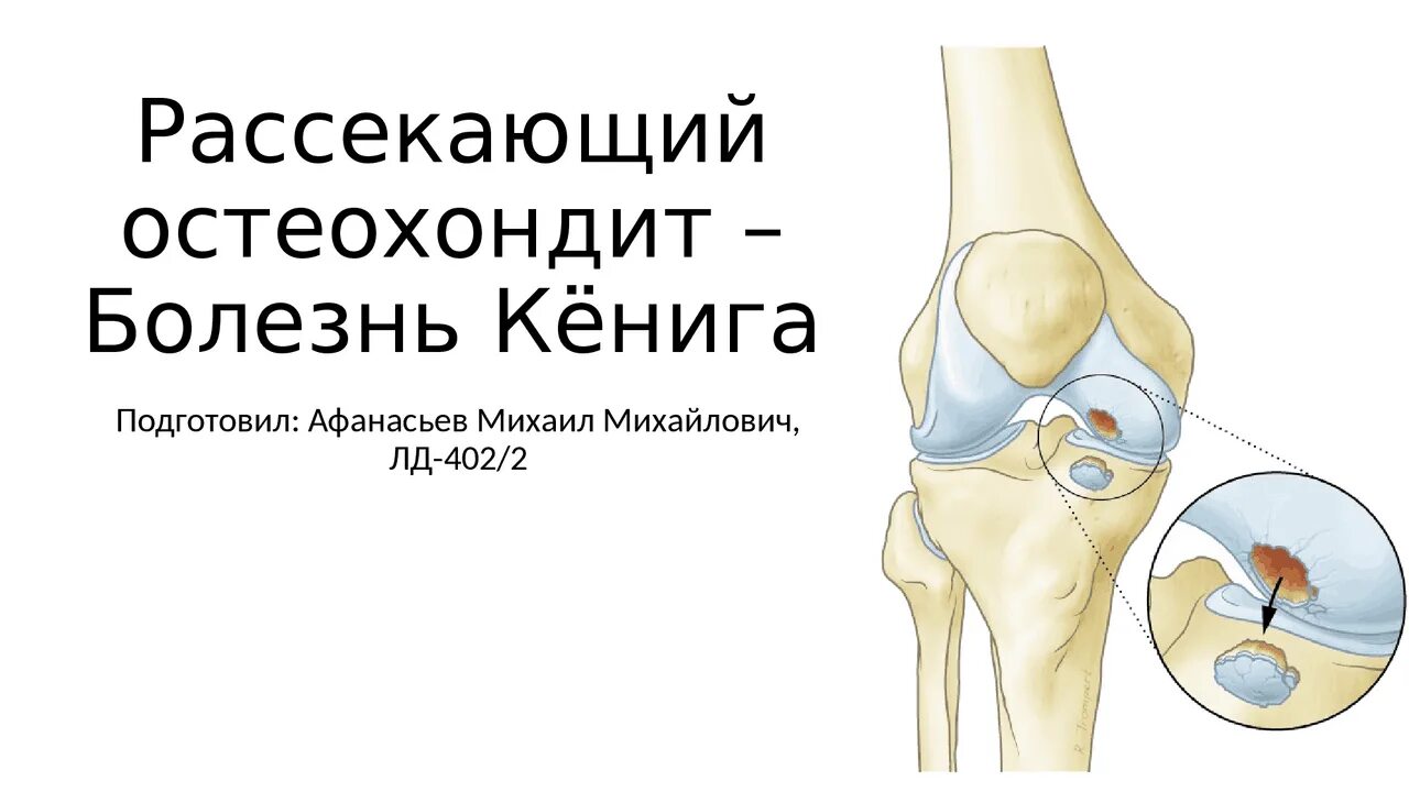 Отек гоффа коленного сустава. Синдром Гоффа коленного сустава. Жировое тело Гоффа коленный сустав. Болезнь Кенига коленного сустава. Клетчатка Гоффа коленного сустава.