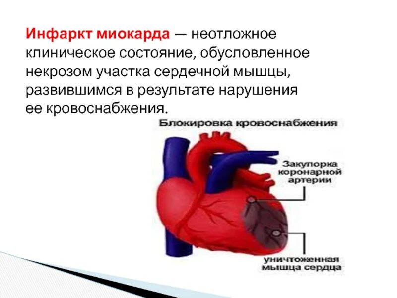 Сосуды при инфаркте миокарда. При инфаркте миокарда в сердечной мышце развивается. энзимодиагностика инфаркта миокарда. презентация на тему инфаркт миокарда.