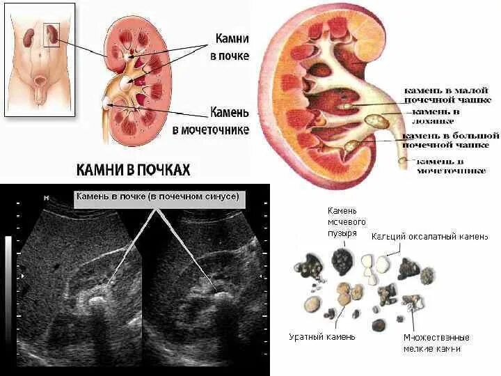 Чашечка почки камни в почке. Камни в почках (конкременты). Формирование конкрементов в почках.