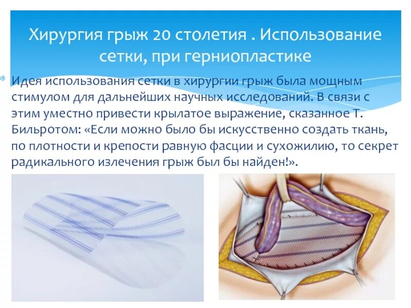 Герниопластика паховой грыжи с сеткой. Паховая грыжа грыжесечение. Сетка для герниопластики грыжи.