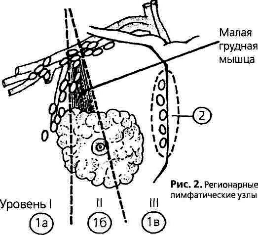 Лимфатические узлы молочной железы схема. Регионарные лимфатические узлы молочной. Молочная железа регионарные лимфатические узлы. Уровни лимфатических узлов молочной железы. Лимфоузлы молочных желез норма