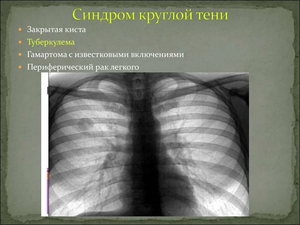 Округлыми формами в легком. Кольцевидная тень туберкулема. Кольцевидная тень в легком при туберкулезе. Круглая тень на рентгенограмме легких. Синдром круглой тени на рентгенограмме.