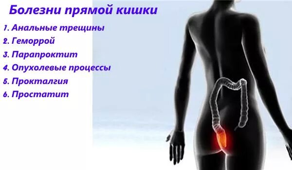 Боль в прямой кишке заднем