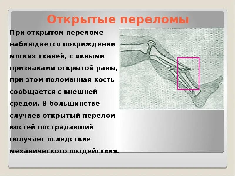 При открытом переломе отломки в ране. Открытые переломы доклад. Презентация на тему открытый перелом.