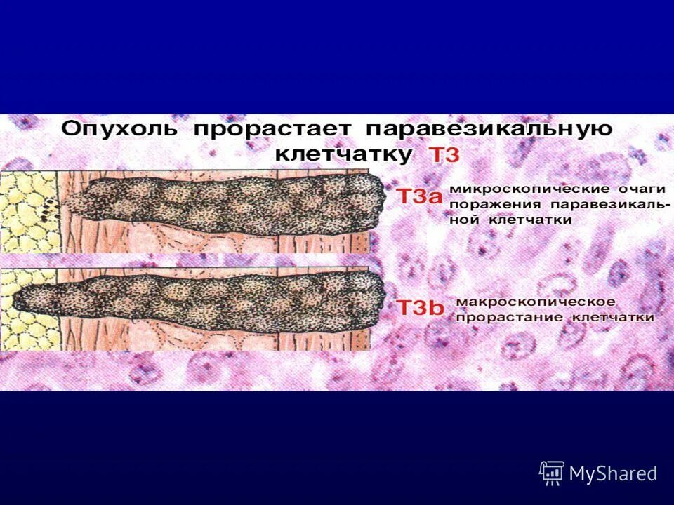 Паравезикальная клетчатка мочевого пузыря. Инфильтрацию паравезикальной клетчатки мочевого. Паравезикальноц клетчаька это. Новообразование паравезикальной клетчатки.