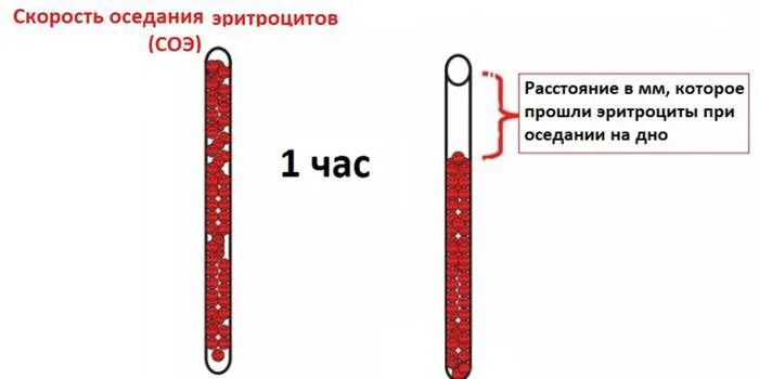 Без соэ. Скорость оседания эритроцитов. Скорость оседания СОЭ. Метод Панченкова СОЭ. Измерение СОЭ по Панченкову.