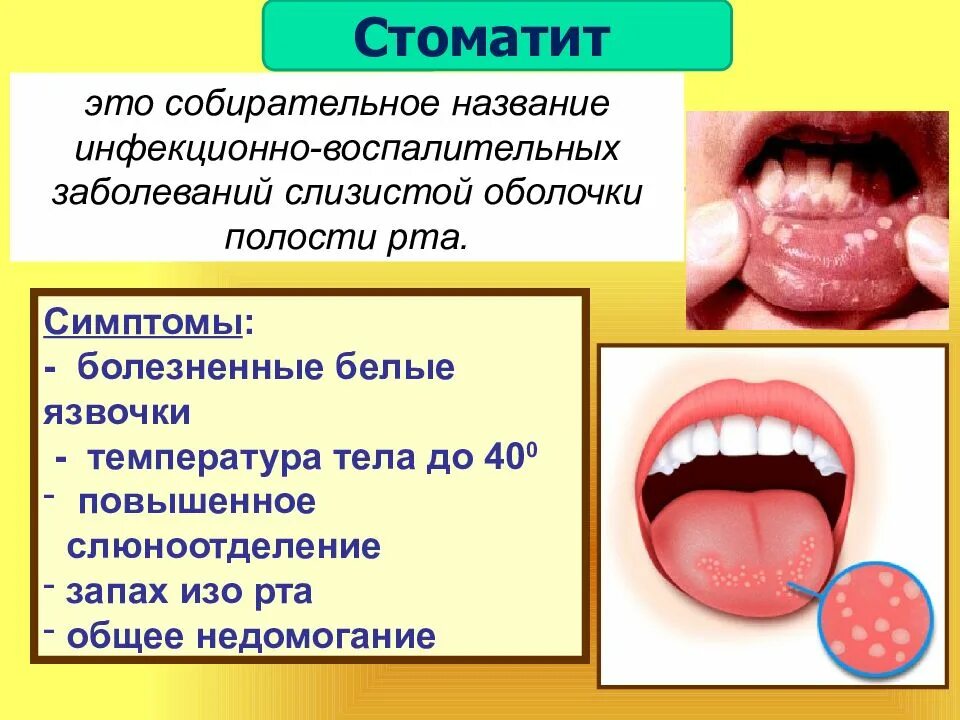 Слюна после еды. Стомотрт. Стлпатит. Стаомоит.