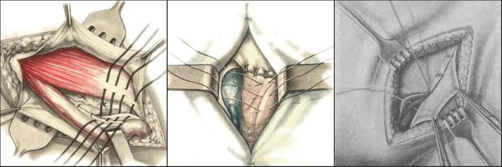 Можно удалить грыжу паховую. Операция при паховой грыже. Паховая грыжа операция дюамеля. Паховая грыжа операция название. Грыжевой мешок врожденной грыжи образован.