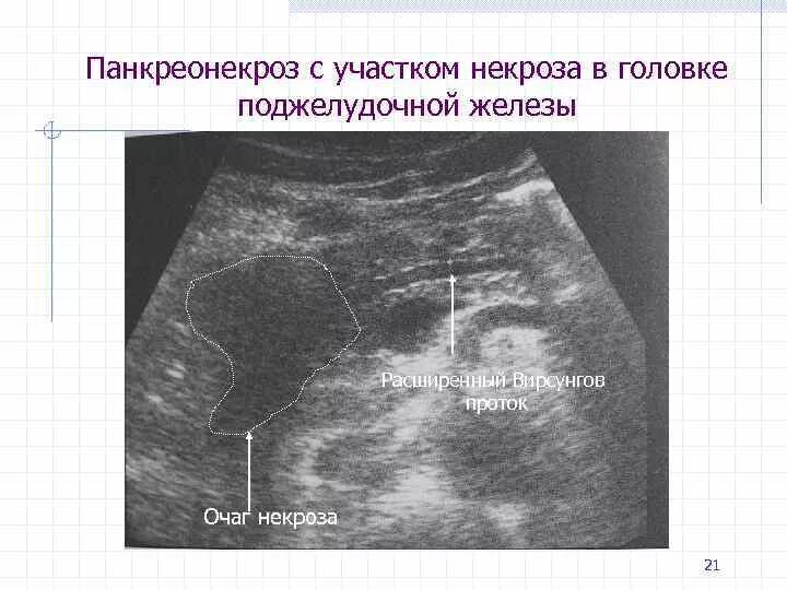 Расширение вирсунгова протока поджелудочной железы на УЗИ. Ультрасонография поджелудочной железы. Некроз поджелудочной железы на УЗИ. Расширение вирсунгова протока на УЗИ. Расширен проток поджелудочной