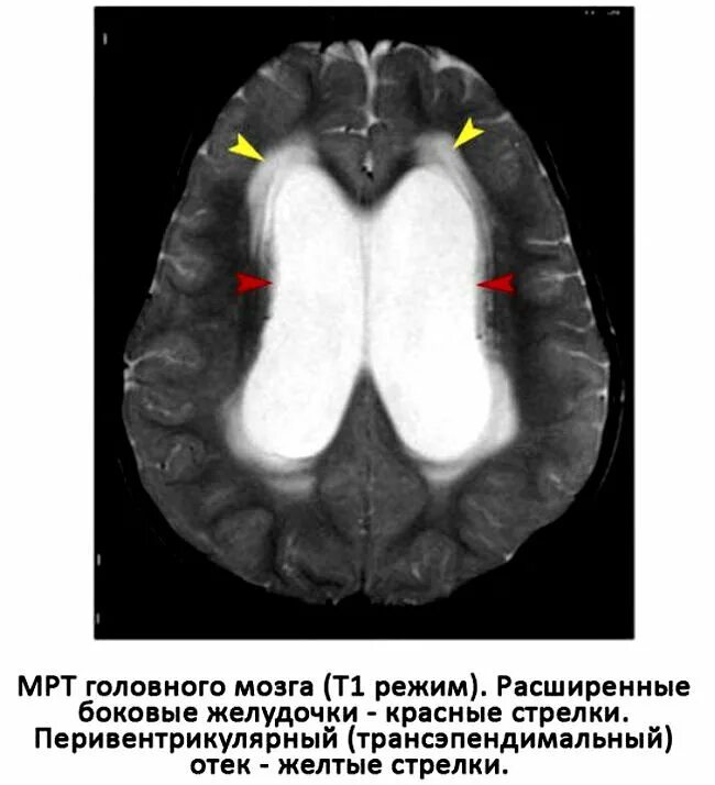 Внутренняя окклюзионная гидроцефалия мрт. Мрт снимки наружная гидроцефалия. Расширение желудочков кт. Наружная гидроцефалия на кт признаки. Расширение желудочков мозга у ребенка