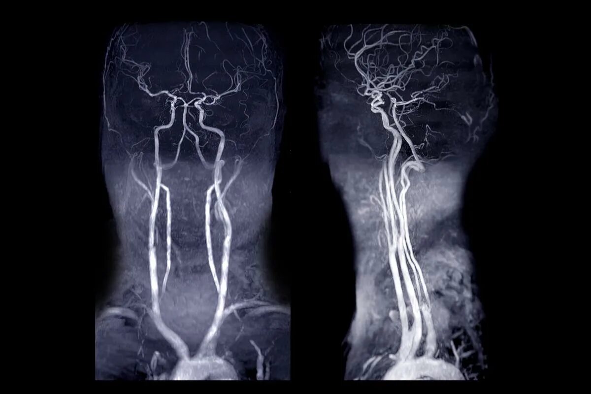 Венография головного мозга. МР-ангиография. Мрт ангиография сонных артерий. МРА. Ангиография картинки прикольные.