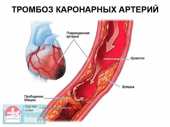 Тромбозный инфаркт миокарда. Тромбоэмболии коронарного сосуда. Тромбоз эмболия инфаркт. Закупорка коронарного сосуда тромбом. Эмболия тромбы