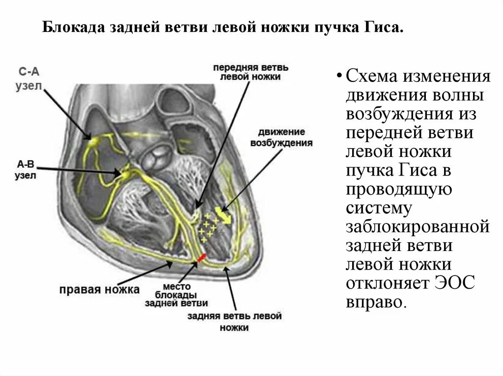 Блокада задней ножки. Блокада передней и задней ветви пучка Гиса. Блокада задней ножки пучка Гиса на ЭКГ. Блокада срединной ветви пучка Гиса на ЭКГ. Левая блокада ножки пучка Гиса.