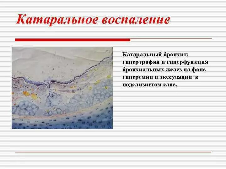 Катаральное воспаление характеристика воспаления. Виды катарального воспаления. Острое катаральное воспаление. Исход острого катарального воспаления. Катаральное воспаление верхних дыхательных.