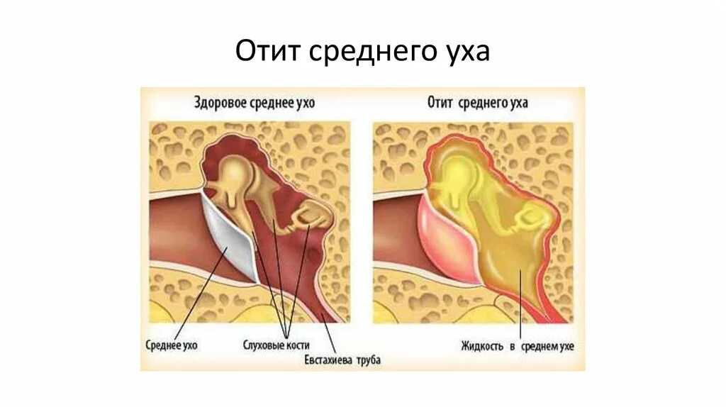 зеленоватые выделения из уха. холестеатома внутреннего уха. гнойный перфоративный отит. острый двусторонний экссудативный отит. с ушей выходит жидкость.