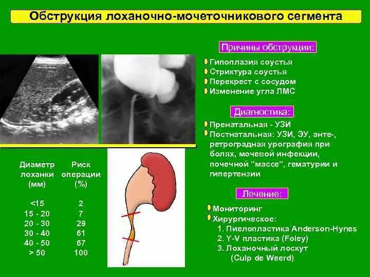 Гидронефроз почки после операции. Обструкция лоханочно-мочеточникового сегмента. лоханочно-мочеточниковый сегмент мочеточника. стриктура лоханочно-мочеточникового сегмента. гидронефроз с обструкцией лоханочно-мочеточникового соединения.