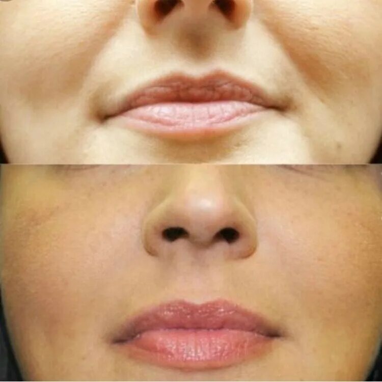 контурная пластика носогубных складок. контурная пластика носогубных складок. контурная пластика носогубка. пластика носогубных складок. контурная пластика носогубки.