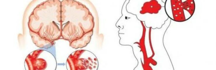 Кровоизлияние в мозг симптомы первые признаки. Внутреннее кровотечение черепное. симптомы кровоизлияния в мозг симптомы.