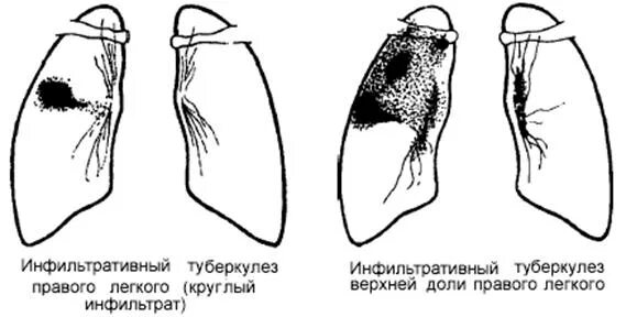 Округлый инфильтрат