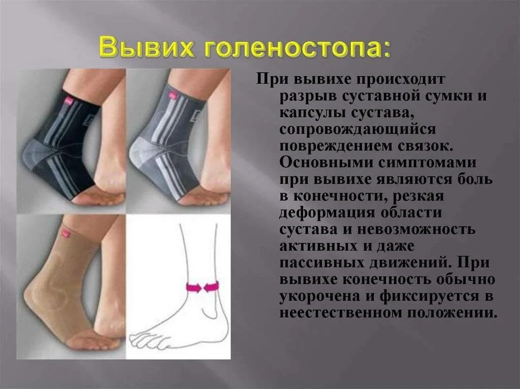 Симптомы растяжения голеностопного. Подвывих голеностопного сустава классификация. надрыв связок голеностопного сустава гематома. неполный разрыв связок голеностопного сустава. вывих лодыжки повреждение связок.