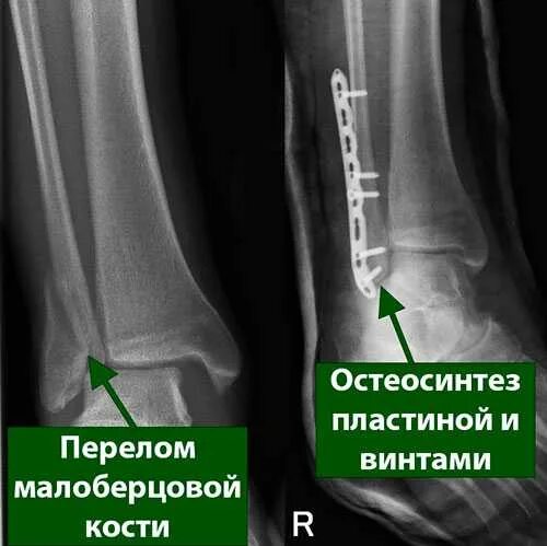 Перелом со смещением нужна операция. Чрезсиндесмозный перелом лодыжки. Закрытый перелом наружной лодыжки малоберцовой кости. Остеосинтез малоберцовой кости и лодыжки. Перелом лодыжек остеосинтез рентген.